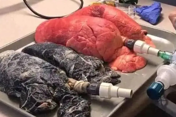 抽了一年电子烟的肺部